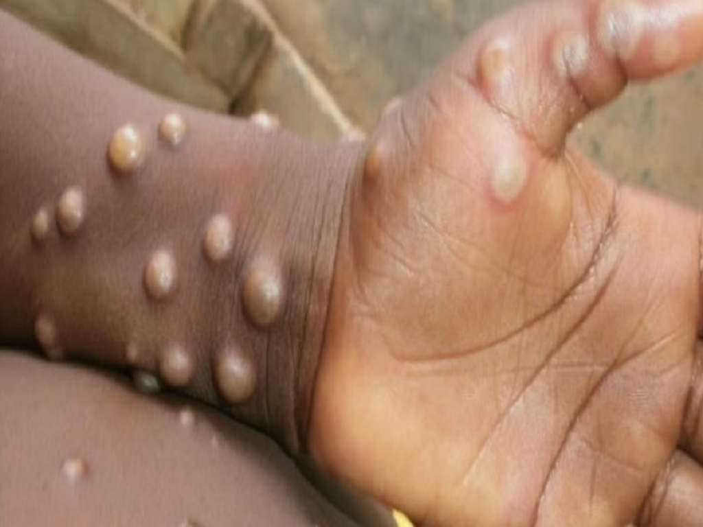 first case of monkeypox detected in delhi in isolation