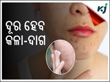 କଳା ଦାଗ କୁ ନେଇ ଚିନ୍ତିତ କି ? ଆପଣାନ୍ତୁ ଏହି ଉପାୟ ........