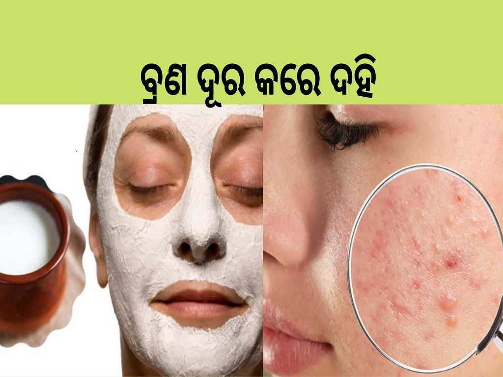 skin care tips dahi or curd very helpful for acne pimples pigmentation