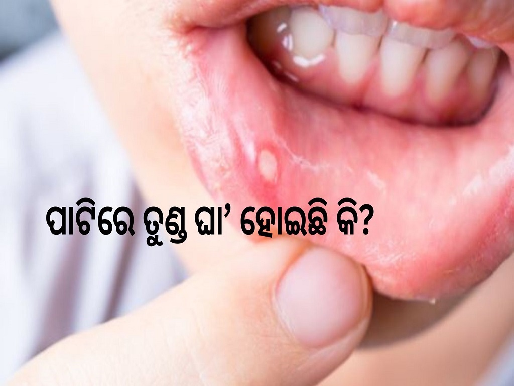 5 Natural Remedies To Get Rid Of Painful Mouth Ulcers