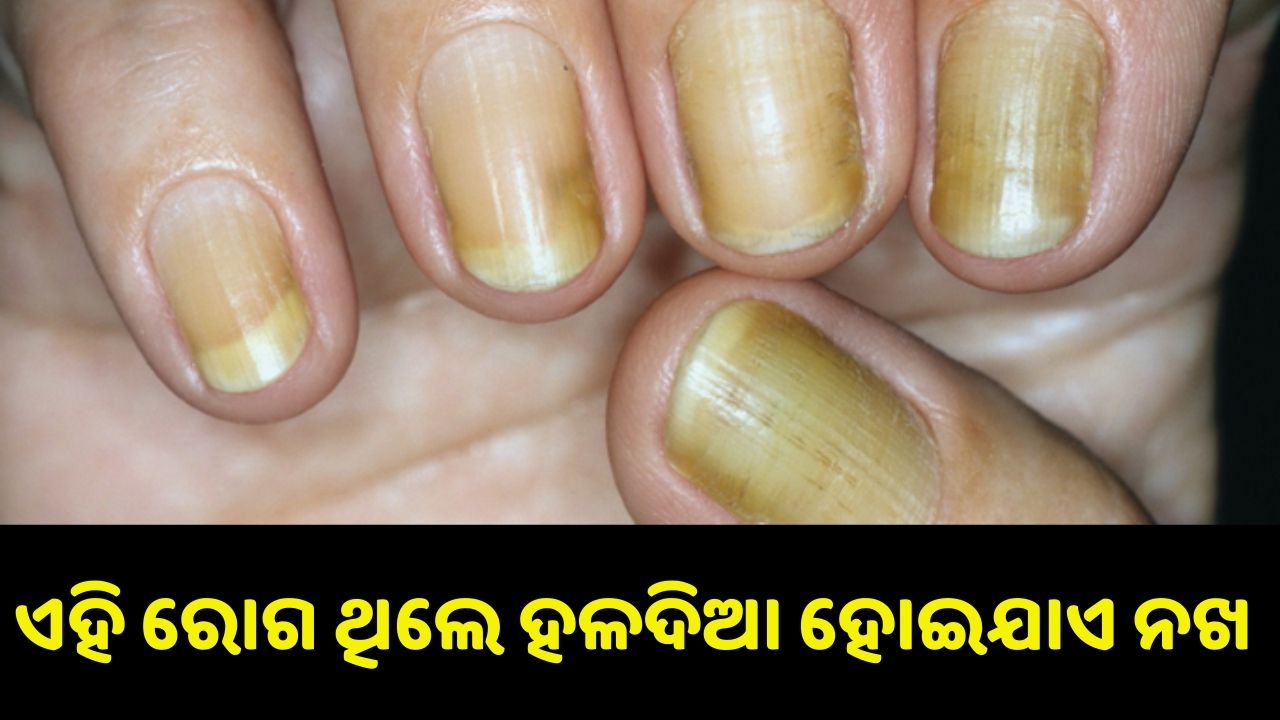 yellow nail syndrome..