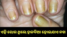 ଏହି ସବୁ ରୋଗ ହେଲେ ହଳଦିଆ ପଡ଼ିଯାଏ ନଖ...
